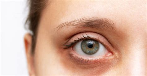 çocuklarda göz altı morlukları neden olur